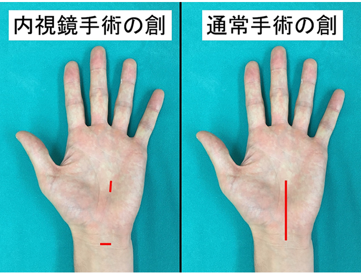 内視鏡手術の創と通常手術の創